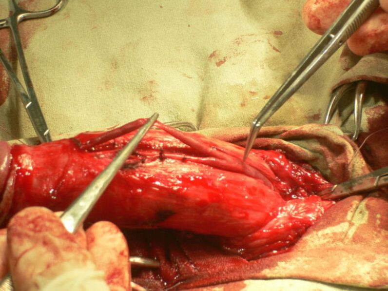 lipofilling of the penis for enlargement